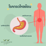 โรคกรดไหลย้อน